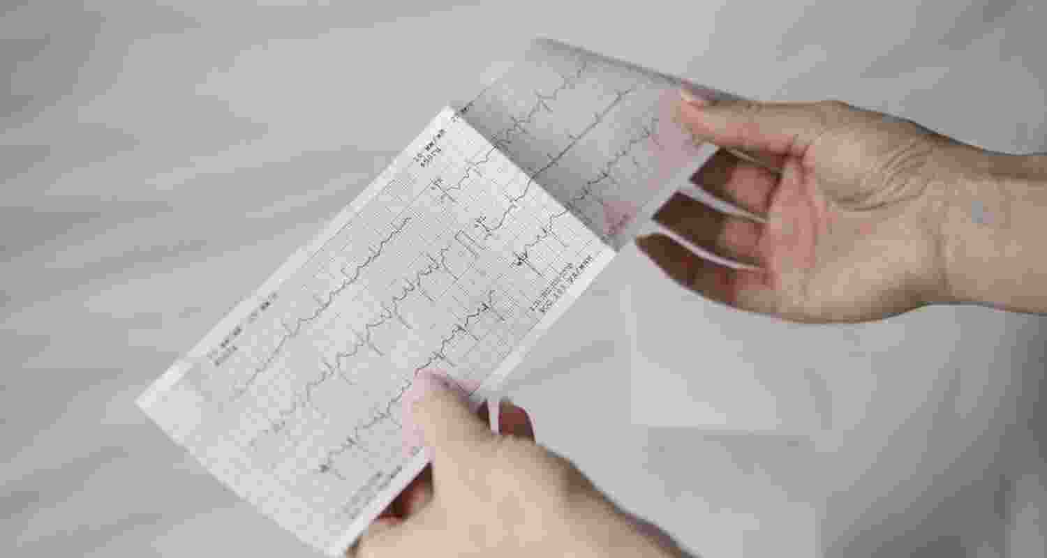What is sudden adult death syndrome?