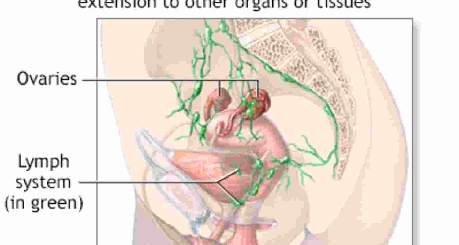 Lymph nodes removal can improve cancer patients' survival
