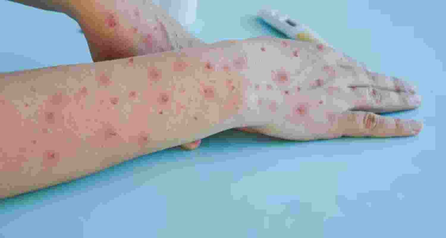 India Alerts Airports Ports Over Rising Mpox Threat. India Alerts Airports Ports Over Rising Mpox Threat.