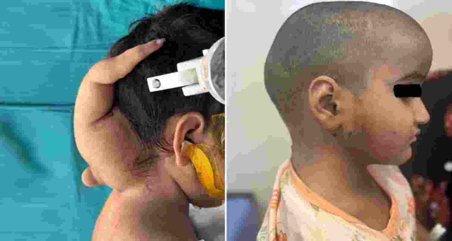 3 yr old Bhopal  girl on whom rare surgery was performed.