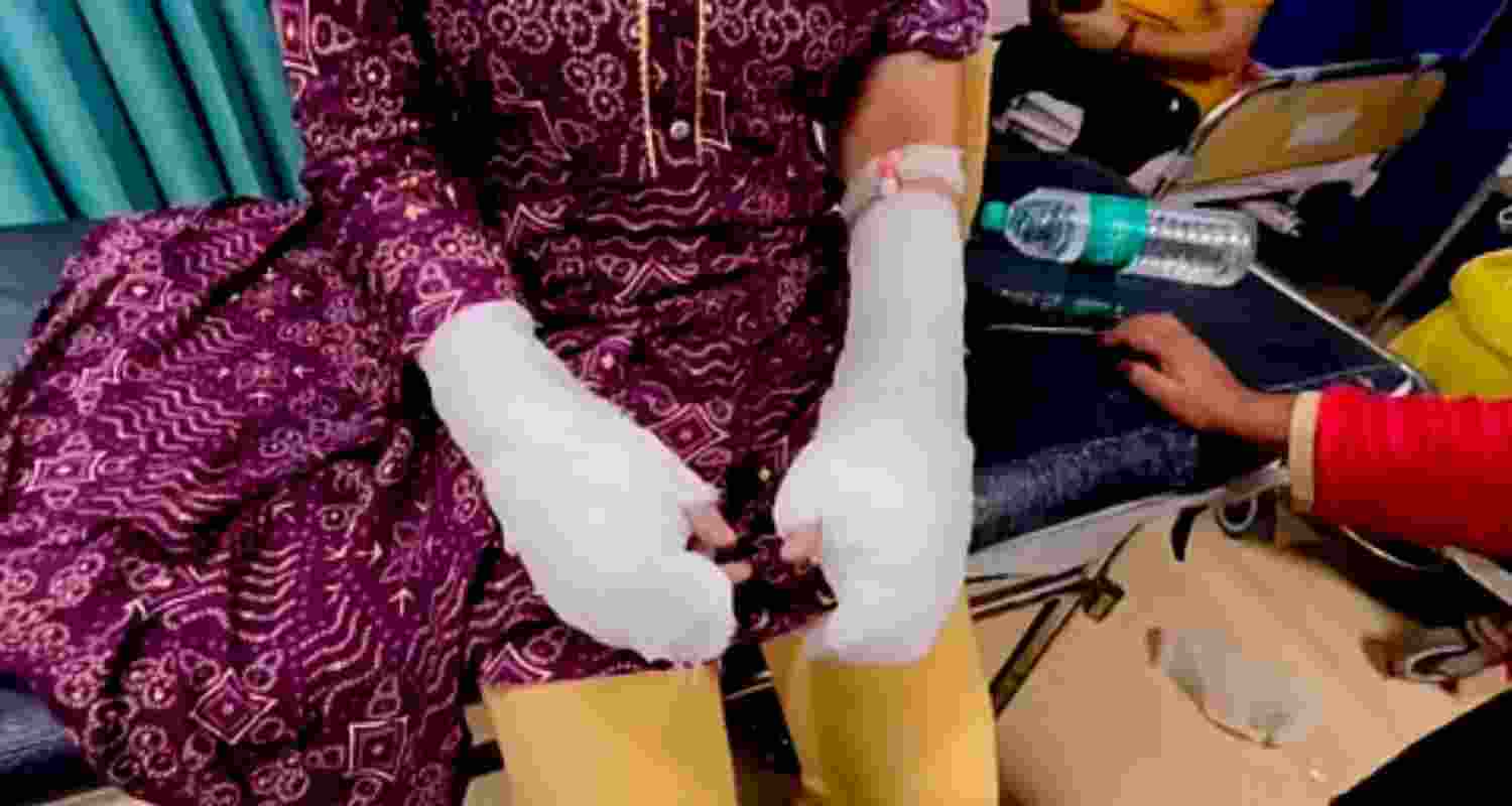 A 20-year-old woman being treated at a hospital after sustaining burn injuries on her hands in an alleged acid attack by her stalker and his associates near Laxmi Bai College, at Ashok Vihar area, in New Delhi, Sunday. A 20-year-old woman being treated at a hospital after sustaining burn injuries on her hands in an alleged acid attack by her stalker and his associates near Laxmi Bai College, at Ashok Vihar area, in New Delhi, Sunday.