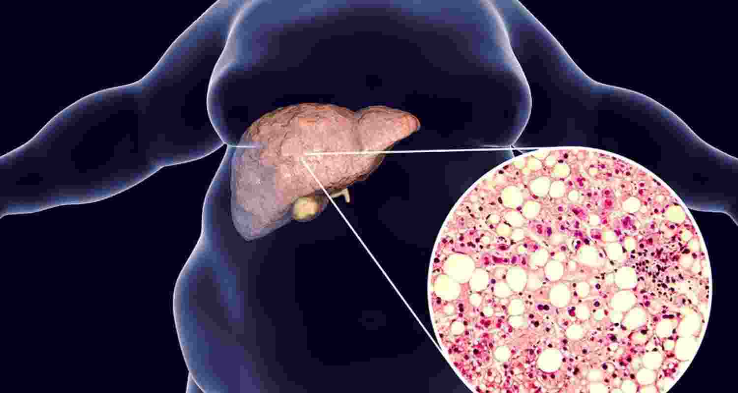 HP launches awareness drive on non-alcoholic fatty liver HP launches awareness drive on non-alcoholic fatty liver