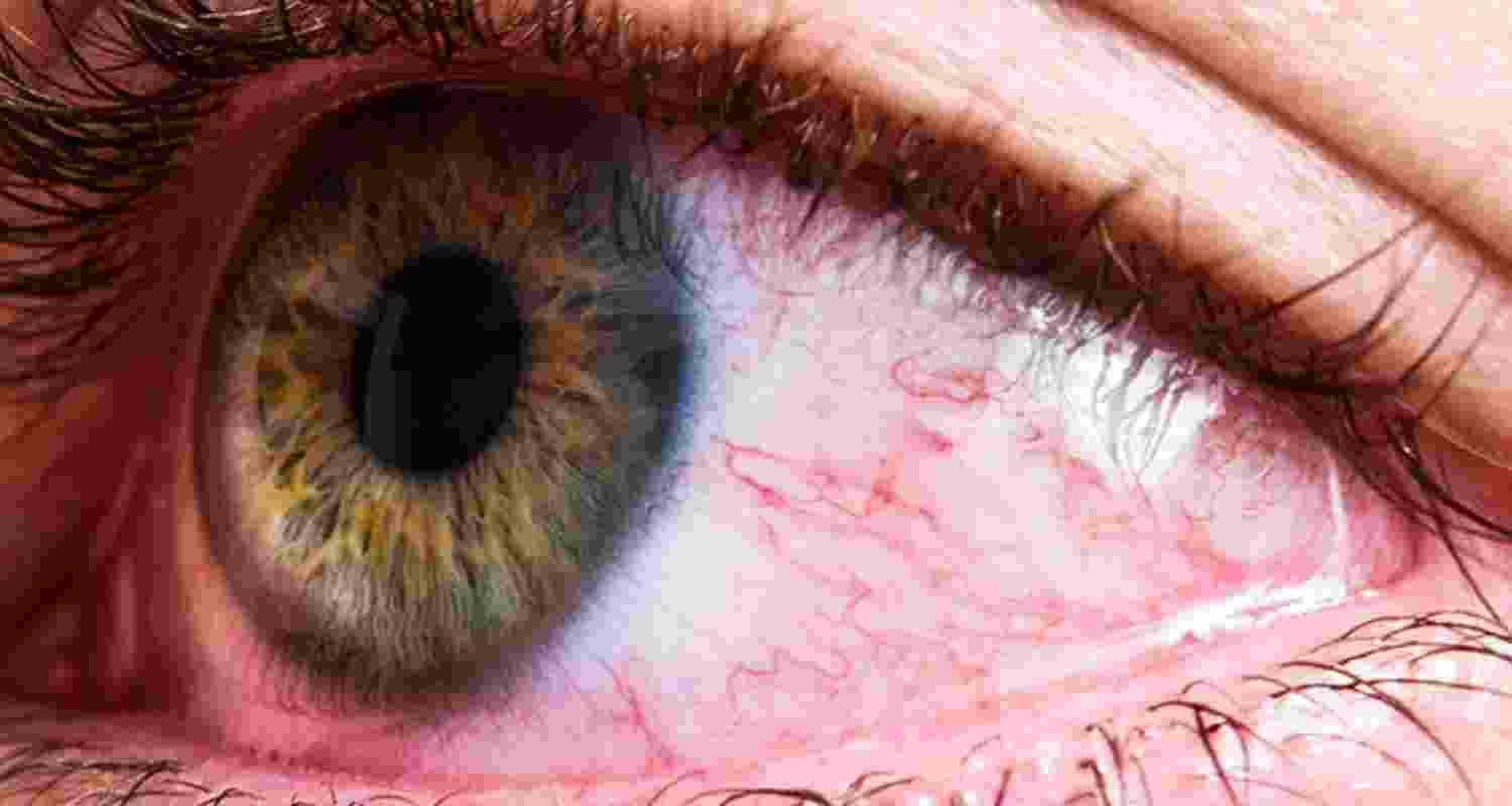 Eye Allergies. Image For Representative Use Only.