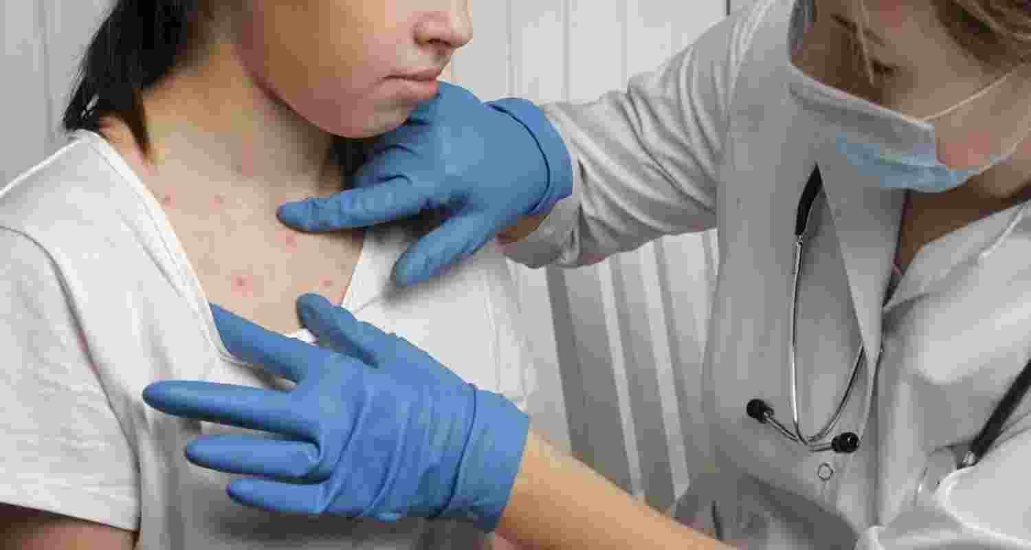 Resurgence of measles a grim sign of next pandemic