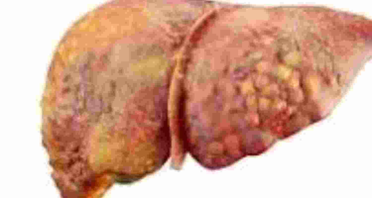 Experts ring alarm bells on rising trend of fatty liver