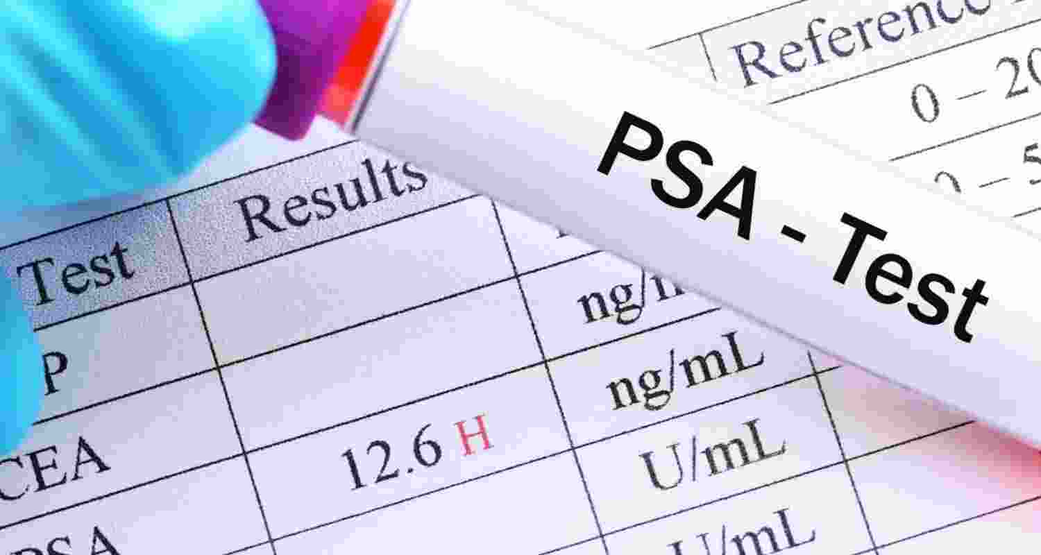 UK advisers reject widespread prostate cancer screening