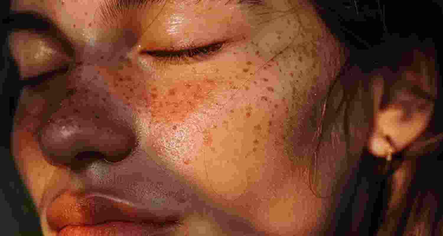 TikTok 'sunburning' trend may cause cancer, not acne relief TikTok 'sunburning' trend may cause cancer, not acne relief