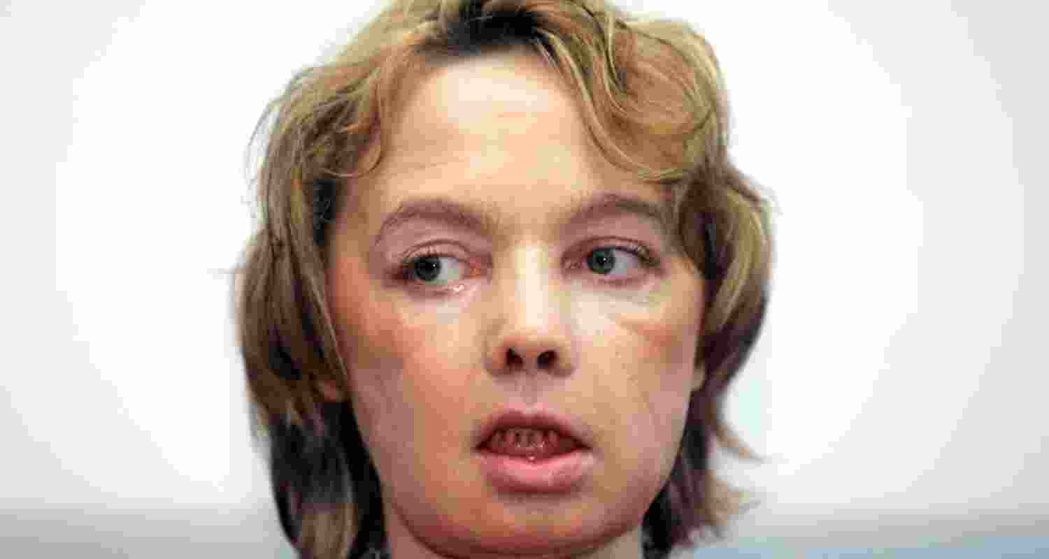 Face transplants: 20 years on, key questions remain Face transplants: 20 years on, key questions remain