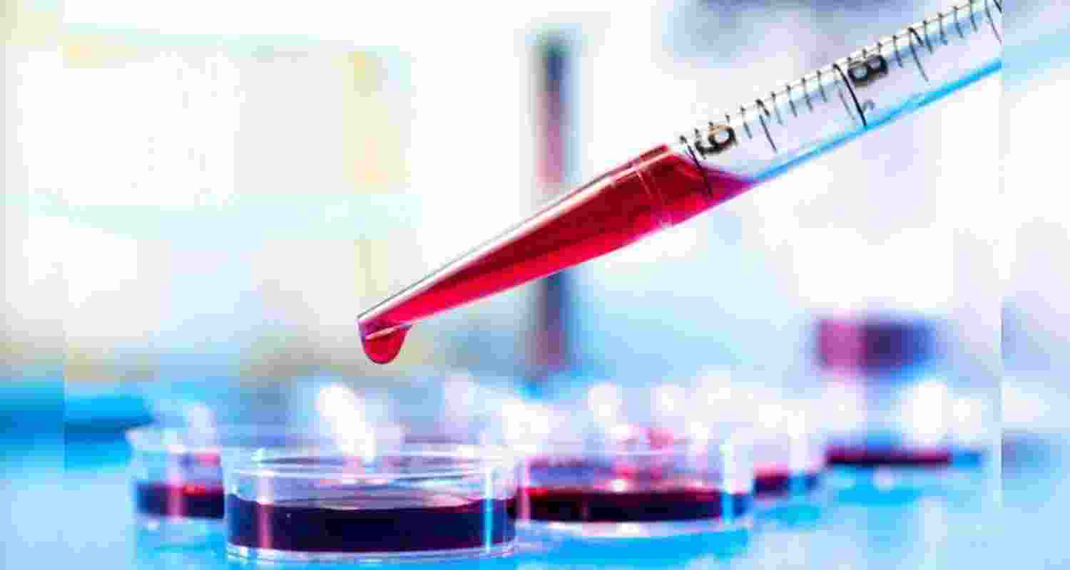 Jharkhand to launch statewide Thalassemia, Sickle Cell screening Jharkhand to launch statewide Thalassemia, Sickle Cell screening